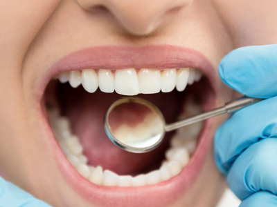 ۶ راه کارآمد برای از بین بردن پلاک دندان به طور طبیعی